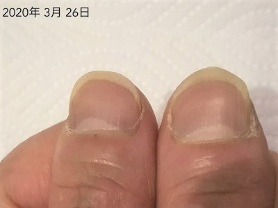 キレイな爪の形にする方法 広島 深爪ケア専門サロン