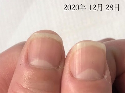 爪むしりの治療はしていませんが 自然に お爪はキレイになります 広島 深爪ケア専門サロン