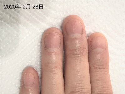 爪の形が嫌いです 縦長に変わりますか のお返事です 広島 深爪ケア専門サロン