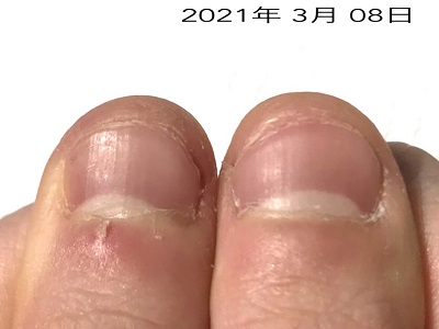 この深爪を治す方法が 自分にあっているか わかります 広島 深爪ケア専門サロン