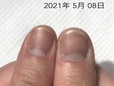 爪周りのささくれや 乾燥も変わってきます 広島 深爪ケア専門サロン