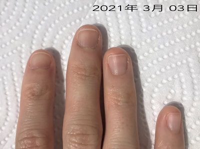 スカルプチャーなし 深爪は 自爪のままでキレイになります 広島 深爪ケア専門サロン
