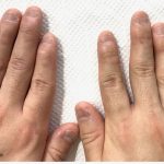 広島で男性の深爪矯正を行う。ジェルなしで爪をむしる癖を改善する専門店。