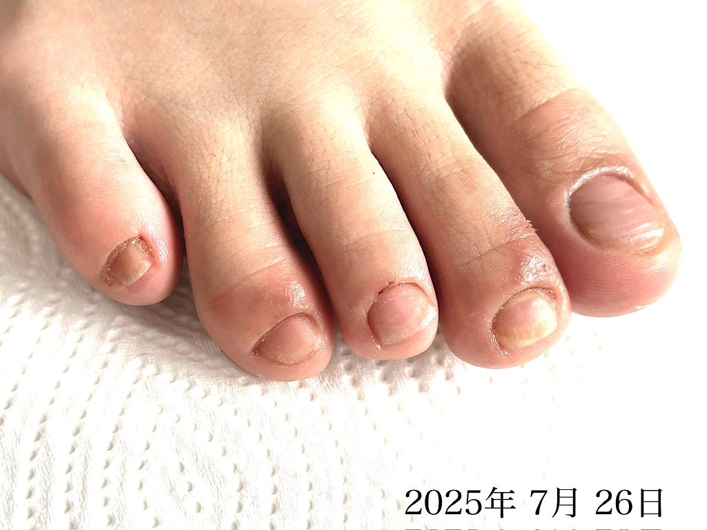 広島のフットネイルケア：１年3ヶ月の自爪育成で健康的に伸びた足の爪