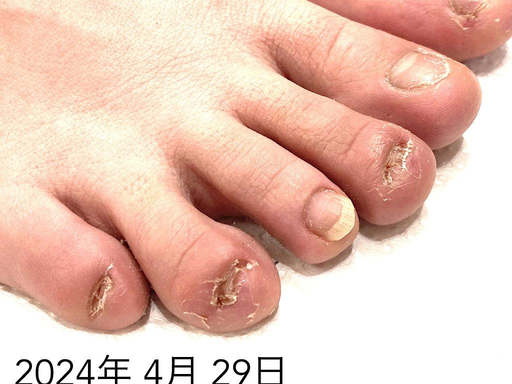広島のフットネイルケア：深爪で悩むお客様の施術前の状態