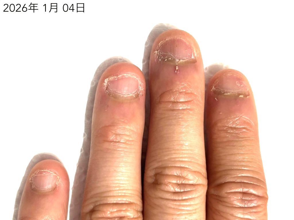 深爪 治らない ビフォー写真２０代男性
