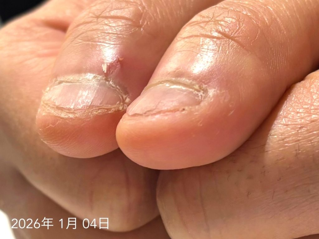 深爪 治らない ビフォー写真２０代男性親指