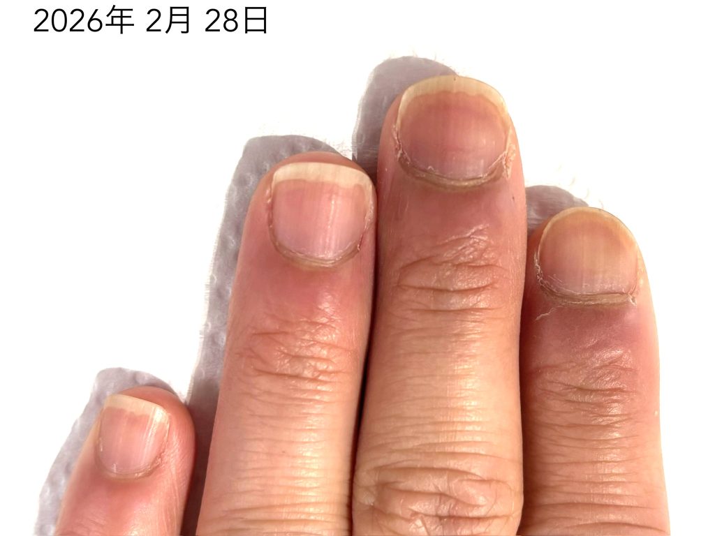 深爪 改善 アフター写真３０代男性