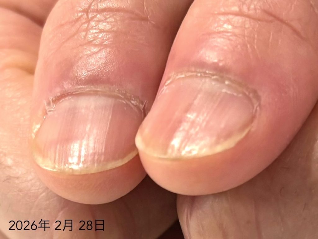 深爪 改善 アフター写真３０代男性親指